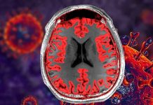 Children with ASD who have language impairment have lower gray matter volume and greater gyrification in the temporal and frontal lobes of the cerebral cortex
