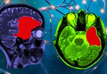 Arachnoid cysts (AC): neurodevelopmental disorders – treatment
