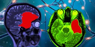 Arachnoid cysts (AC): neurodevelopmental disorders – treatment