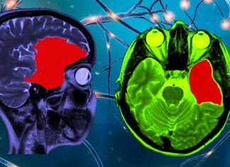 Arachnoid cysts (AC): neurodevelopmental disorders – treatment