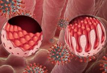 How does COVID-19 affect celiac disease?