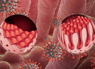 How does COVID-19 affect celiac disease?