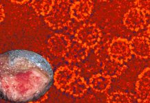 New cases of the rare sexually transmitted Donovanosis virus reported in the UK