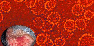 New cases of the rare sexually transmitted Donovanosis virus reported in the UK