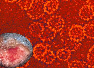 New cases of the rare sexually transmitted Donovanosis virus reported in the UK
