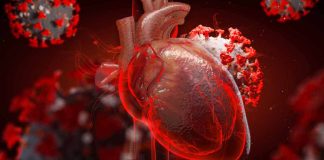 Major adverse cardiac events (MACE) are frequently diagnosed complications of COVID-19
