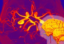 SARS-CoV-2 Infections Can Lead To The Development of Giant Cell Arteritis