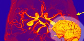 SARS-CoV-2 Infections Can Lead To The Development of Giant Cell Arteritis