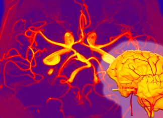 SARS-CoV-2 Infections Can Lead To The Development of Giant Cell Arteritis