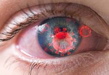 The Impact of COVID-19 Infection on Dry Eye
