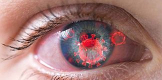 The Impact of COVID-19 Infection on Dry Eye