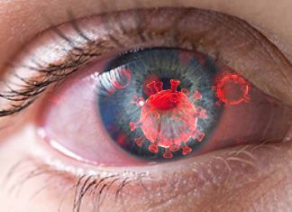 The Impact of COVID-19 Infection on Dry Eye