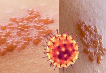I ricercatori hanno trovato un’associazione significativa tra l’infezione da COVID-19 e un aumentato rischio di sviluppare l’herpes zoster (HZ)