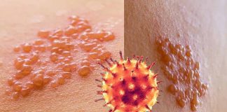 I ricercatori hanno trovato un’associazione significativa tra l’infezione da COVID-19 e un aumentato rischio di sviluppare l’herpes zoster (HZ)
