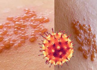 I ricercatori hanno trovato un’associazione significativa tra l’infezione da COVID-19 e un aumentato rischio di sviluppare l’herpes zoster (HZ)