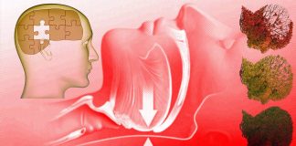 Obstructive Sleep Apnea causes premature cognitive decline