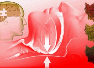 Obstructive Sleep Apnea causes premature cognitive decline
