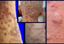 Chronic nodular prurigo – What it is and how to treat it