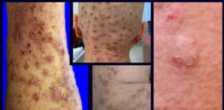 Chronic nodular prurigo – What it is and how to treat it