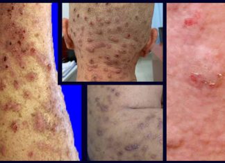 Chronic nodular prurigo – What it is and how to treat it