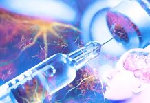 Il farmaco Donanemab rallenta significativamente il declino cognitivo e funzionale nelle persone con malattia di Alzheimer sintomatica precoce