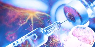 Il farmaco Donanemab rallenta significativamente il declino cognitivo e funzionale nelle persone con malattia di Alzheimer sintomatica precoce