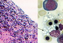 Post-COVID-19 Hemophagocytic Lymphohistiocytosis (HLH)