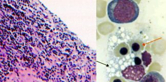 Post-COVID-19 Hemophagocytic Lymphohistiocytosis (HLH)