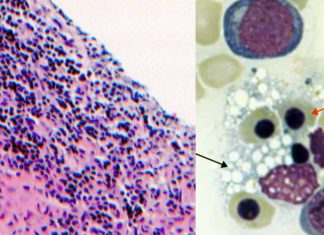 Post-COVID-19 Hemophagocytic Lymphohistiocytosis (HLH)