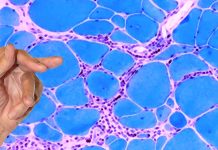 Inclusion body myositis (IBM) – Exploring the Link to COVID-19