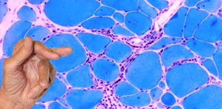 Inclusion body myositis (IBM) – Exploring the Link to COVID-19