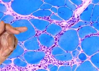 Inclusion body myositis (IBM) – Exploring the Link to COVID-19
