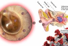 Covid-19 can remain in the middle ear effusion (MEE) long after infection