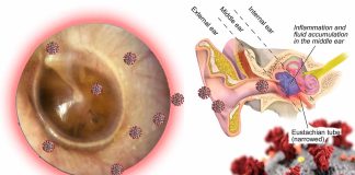 Covid-19 can remain in the middle ear effusion (MEE) long after infection