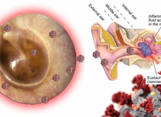 Covid-19 can remain in the middle ear effusion (MEE) long after infection