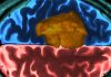 Vorasidenib Shows Significant Improvement in Progression-Free Survival for Patients with IDH-Mutant Grade 2 Gliomas