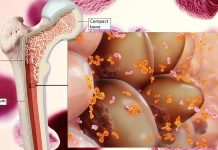 Overcoming Drug Resistance in Multiple Myeloma: Targeting Bone Marrow with Nanoparticle-Mediated siRNA Delivery