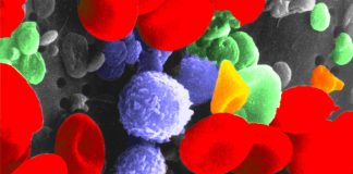 Alterazioni dei globuli rossi nell’infezione pediatrica da SARS-CoV-2: implicazioni per la patologia della malattia e il COVID lungo