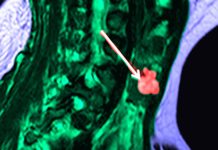 Thyroid Incidentalomas in Hospitalized Patients with COVID-19: Prevalence and Associated Factors