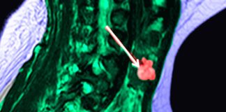 Thyroid Incidentalomas in Hospitalized Patients with COVID-19: Prevalence and Associated Factors