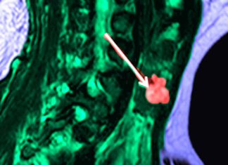 Thyroid Incidentalomas in Hospitalized Patients with COVID-19: Prevalence and Associated Factors