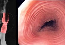 Targeting the NLRP3/Caspase-1 Regulated IL-18 Pathway for Effective Treatment of Eosinophilic Esophagitis