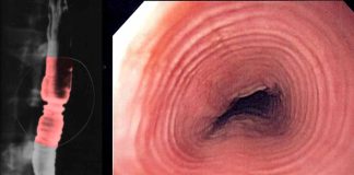 Targeting the NLRP3/Caspase-1 Regulated IL-18 Pathway for Effective Treatment of Eosinophilic Esophagitis