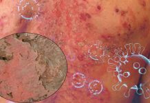 Exploring the Possible Link between Stevens-Johnson Syndrome and COVID-19