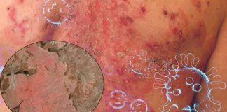Exploring the Possible Link between Stevens-Johnson Syndrome and COVID-19