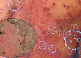 Exploring the Possible Link between Stevens-Johnson Syndrome and COVID-19