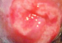 Genital Ulcers as a Manifestation of COVID-19: A Detailed Exploration of Diagnosis and Clinical Significance
