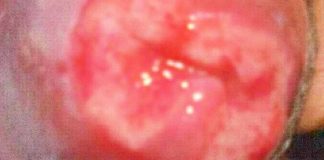 Genital Ulcers as a Manifestation of COVID-19: A Detailed Exploration of Diagnosis and Clinical Significance