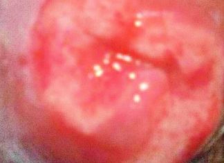 Genital Ulcers as a Manifestation of COVID-19: A Detailed Exploration of Diagnosis and Clinical Significance