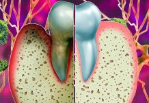 The Impact of Tooth Loss and Periodontitis on Hippocampal Atrophy: A Longitudinal Study in Late Middle-Aged and Older Adults